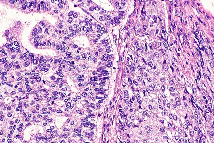 Facts About Adenosquamous Carcinoma Of Lung