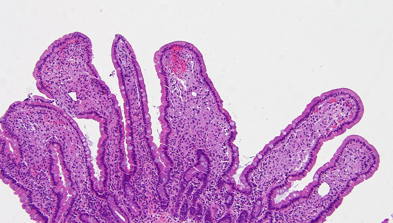 What Is Whipple’s Disease forecast What Is Whipple’s Disease forecast