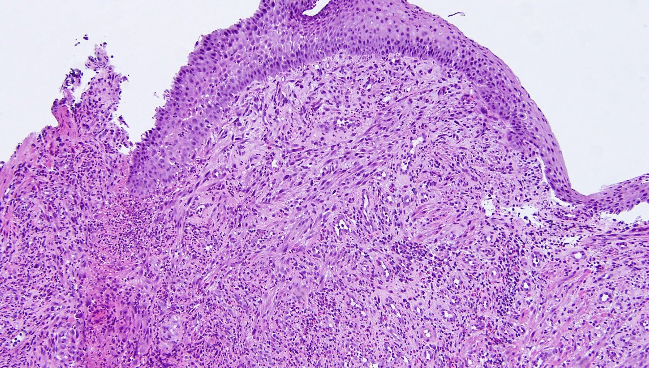 Pyogenic Granuloma