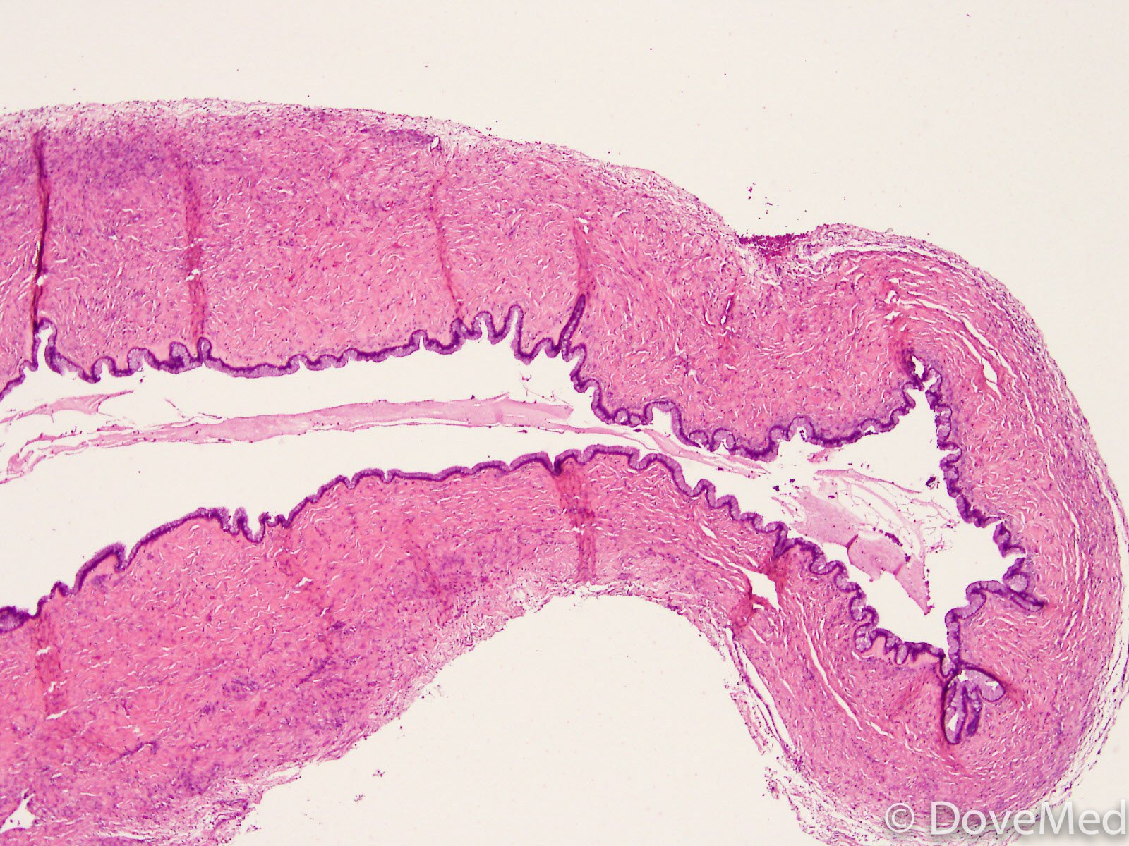 Benign Mucinous Cystadenoma Of Ovary