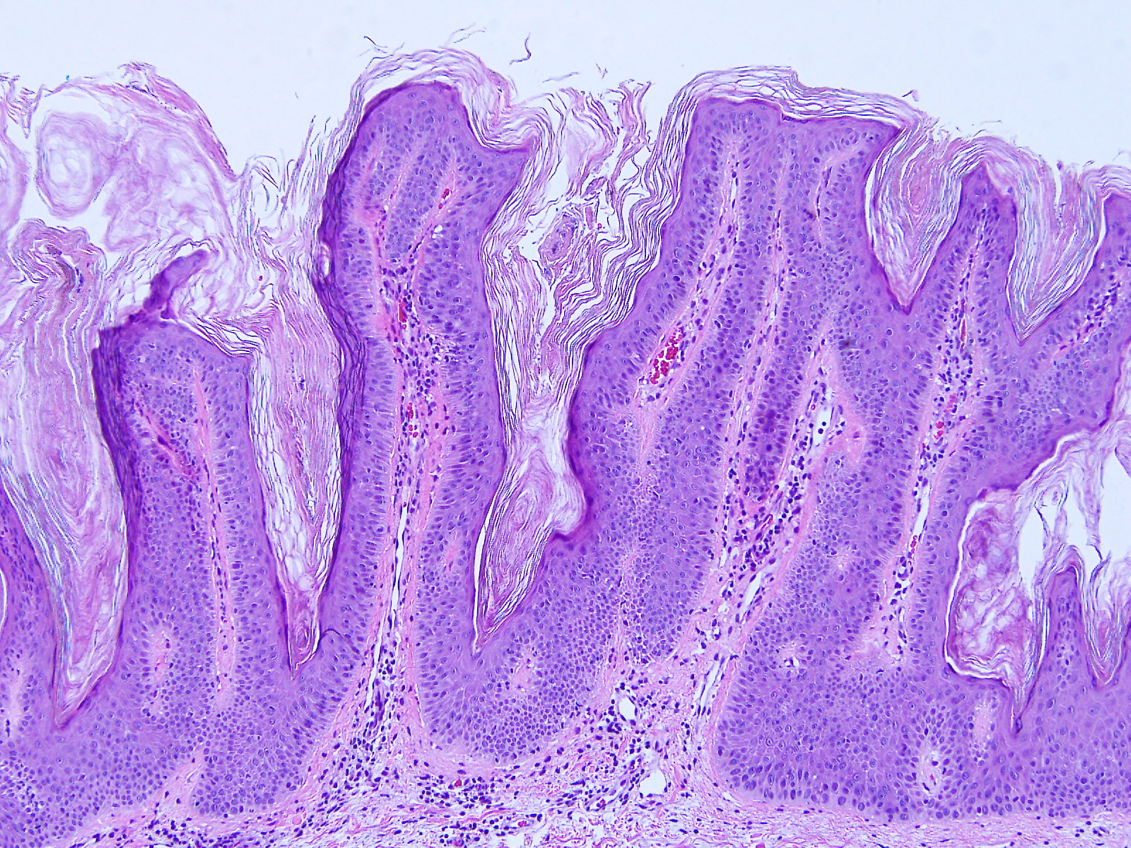 First Topical Treatment For Common Benign Skin Lesions