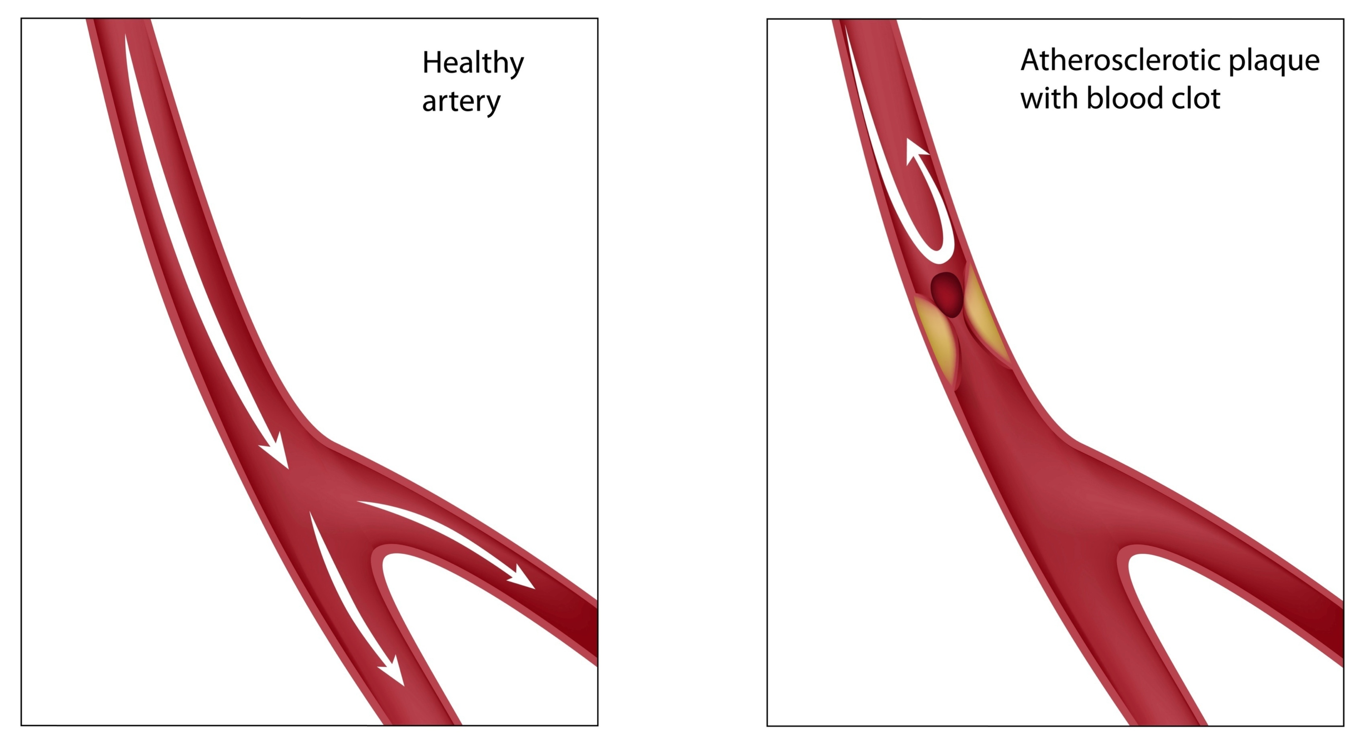 What Is The General Medical Term For Hardening Of The Arteries