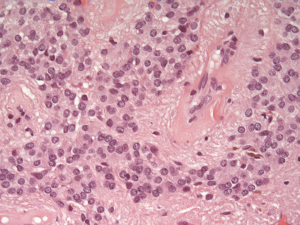 Ependymoma