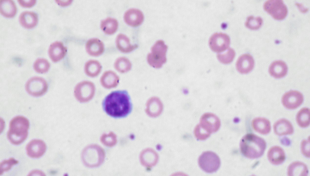 Peripheral Blood Smear Examination