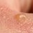 Blister.
