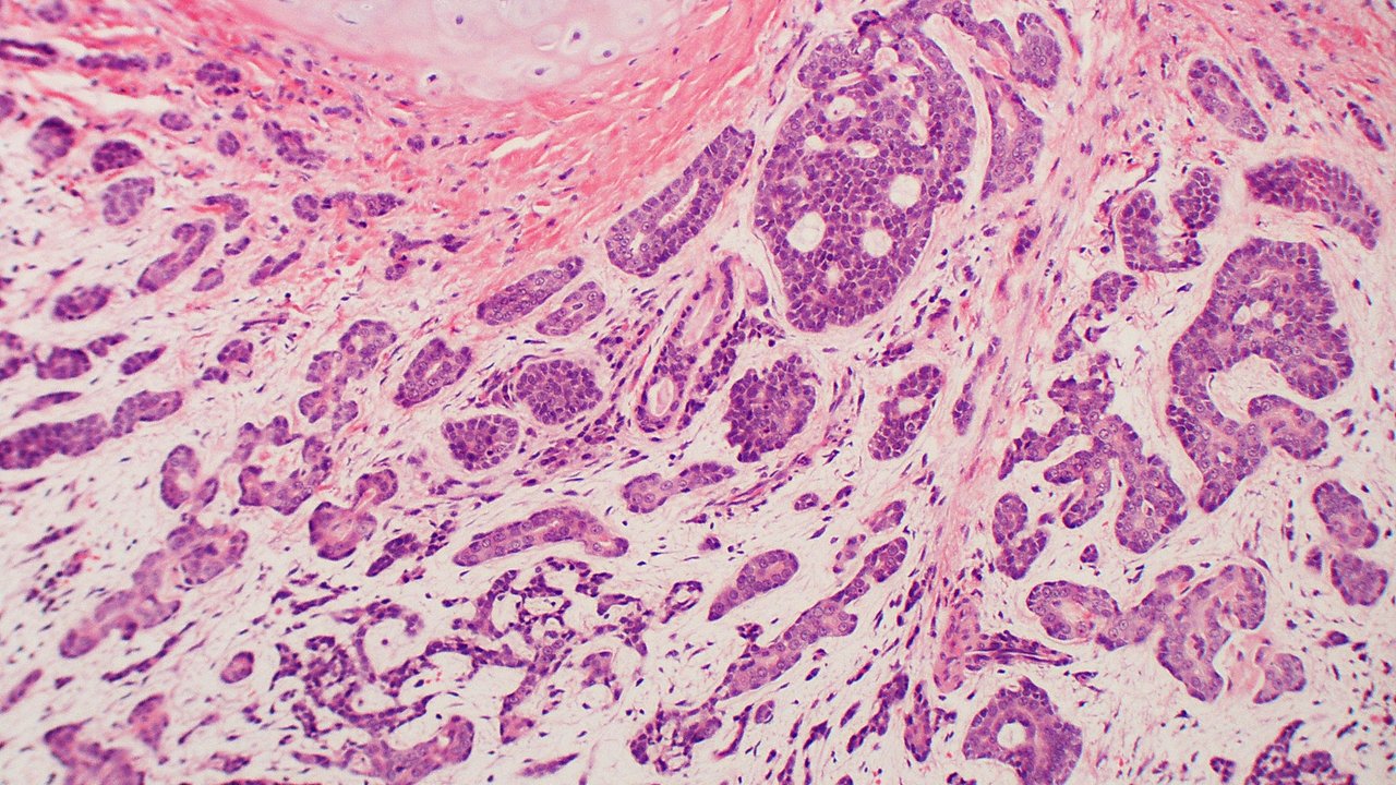 Adenoid Cystic Carcinoma of Lacrimal Gland