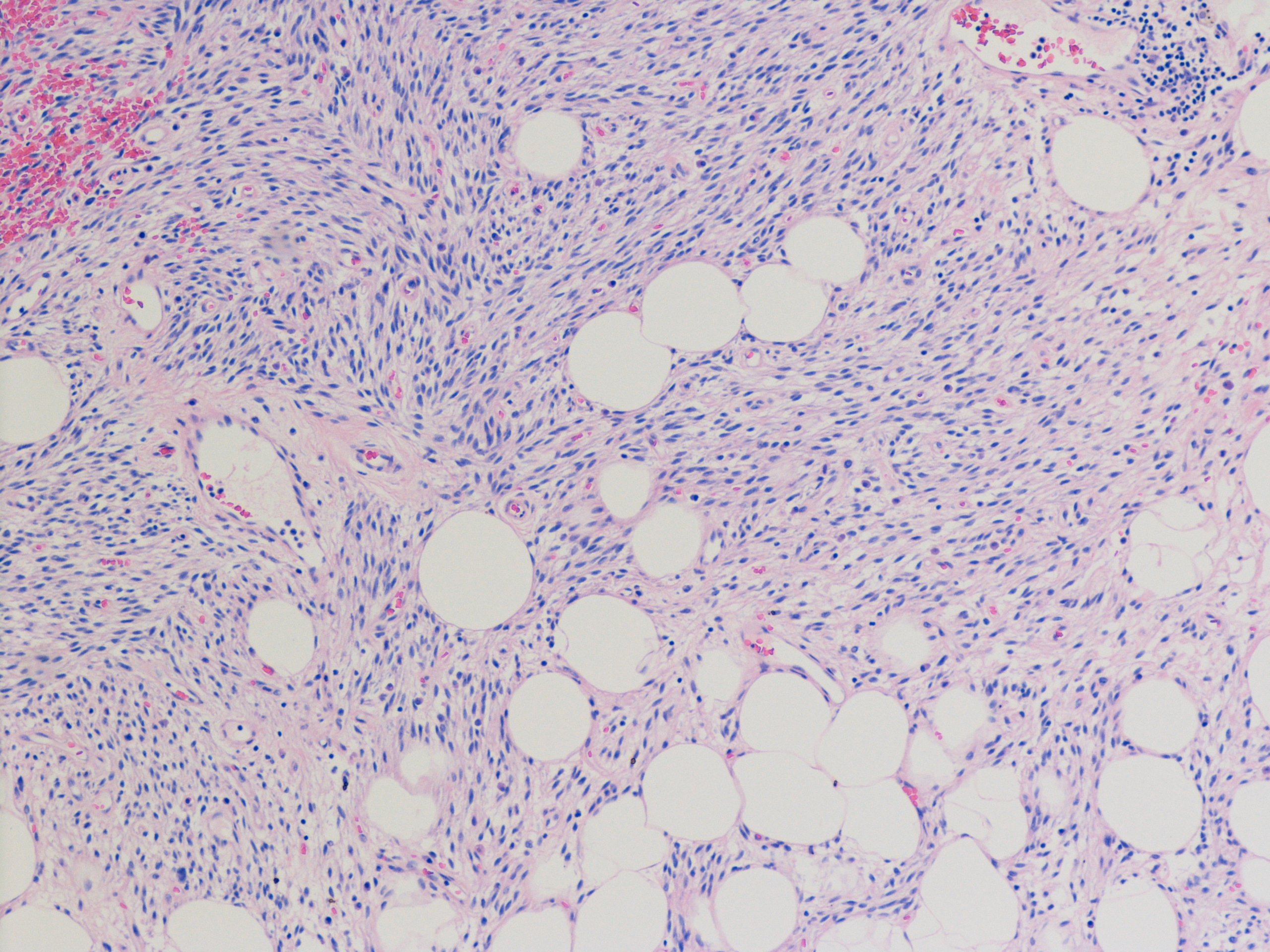 spindle-cell-lipoma