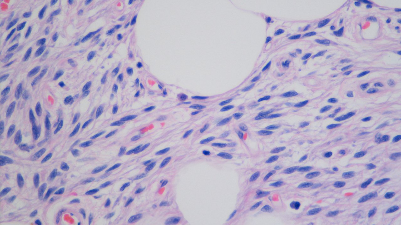 Curcumin disrupts uterine leiomyosarcoma cells through AKT 