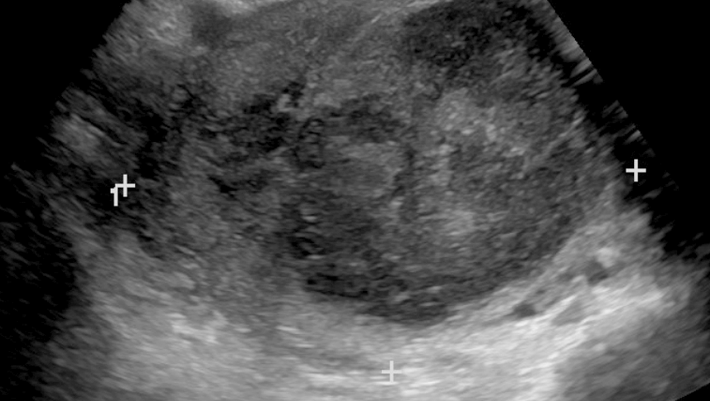 Ovarian Vein Embolization