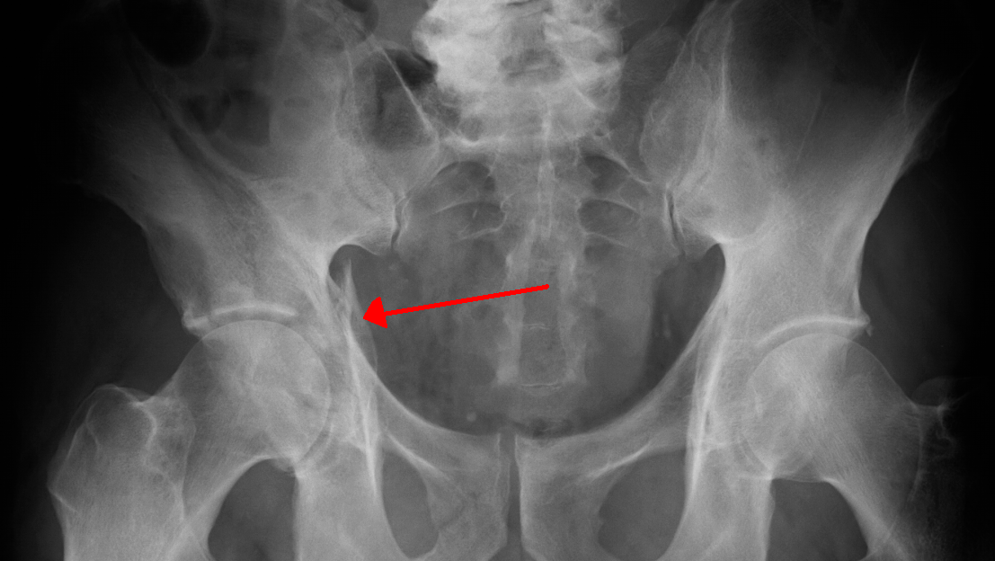 pelvic-fracture