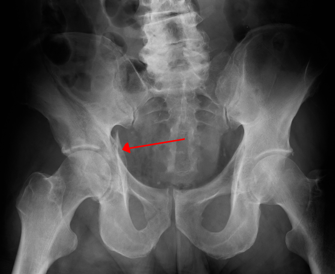 normal hip xray pathologic fracture hip xray