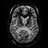 Adrenoleukodystrophy (ALD)