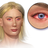Allergic Conjunctivitis.