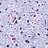 Microscopic pathology image showing senile plaques seen in the cerebral cortex in a patient with presenile onset of Alzheimer disease. Bowdian stain.