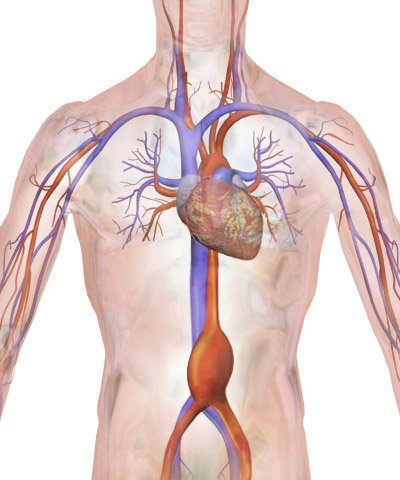 Abdominal Aortic Aneurysm AAA Repair