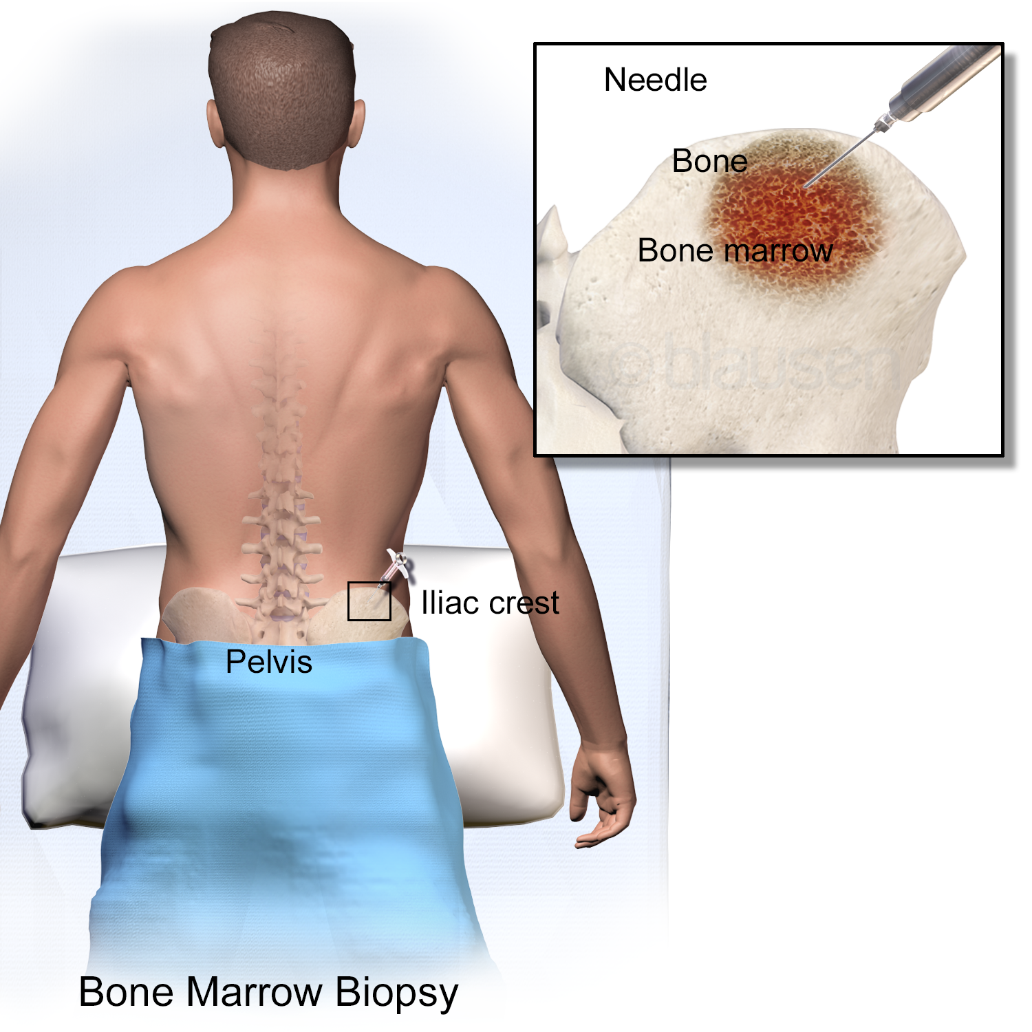 bone-marrow-cancer-what-is-bone-marrow-cancer-types-symptoms-and