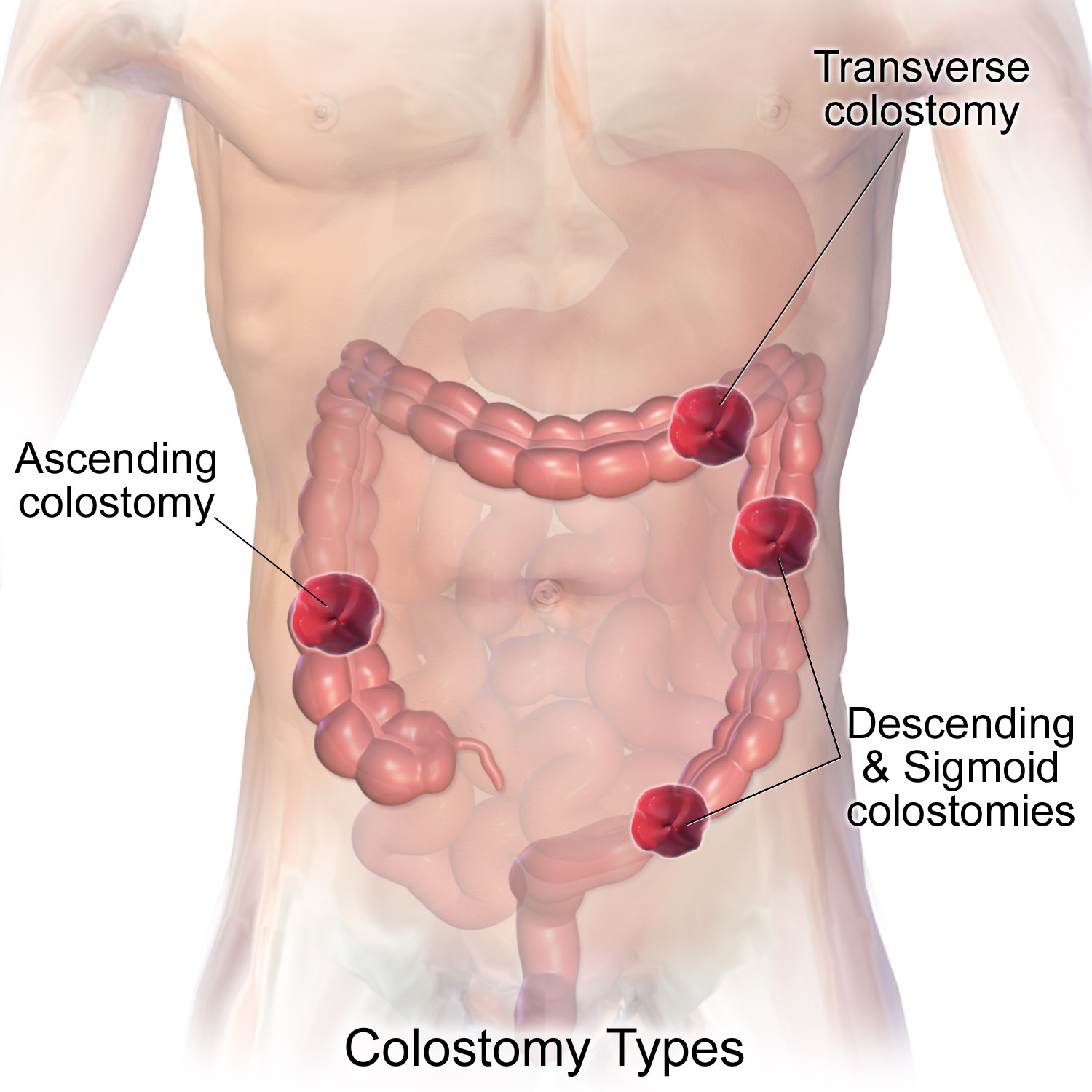 colostomy