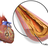Coronary Artery Plaque