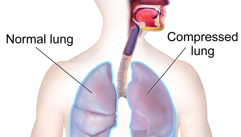 Pleural Effusion