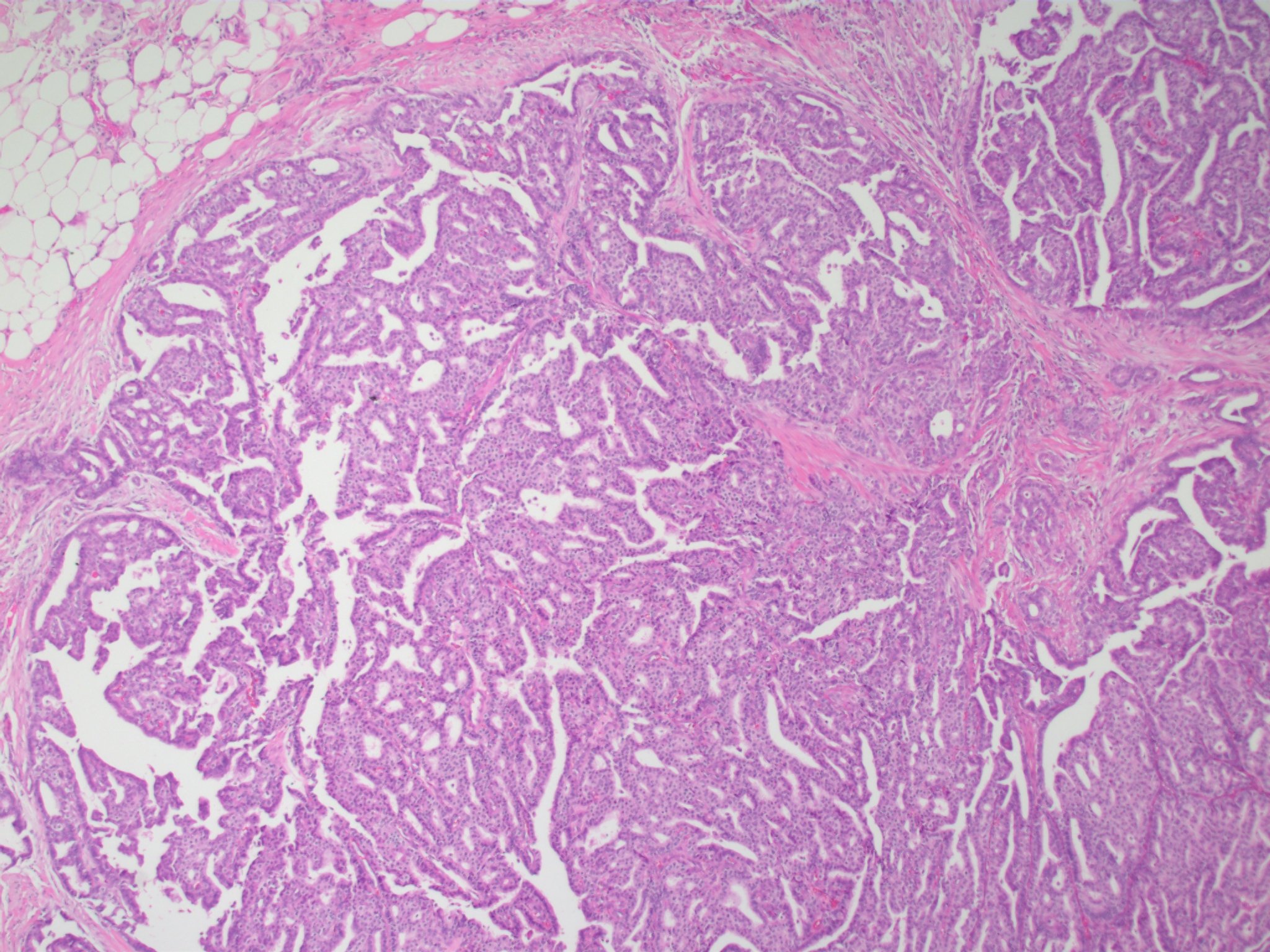 Invasive Papillary Carcinoma Of Breast