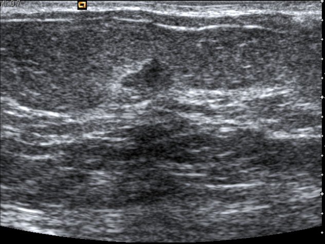 UltrasoundGuided Biopsy of Breast