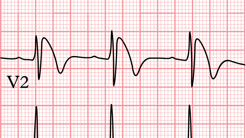 Brugada Syndrome