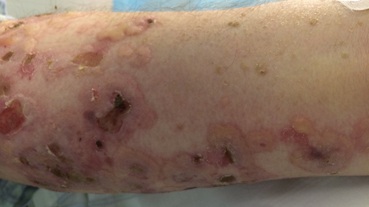 Bullous Pemphigoid