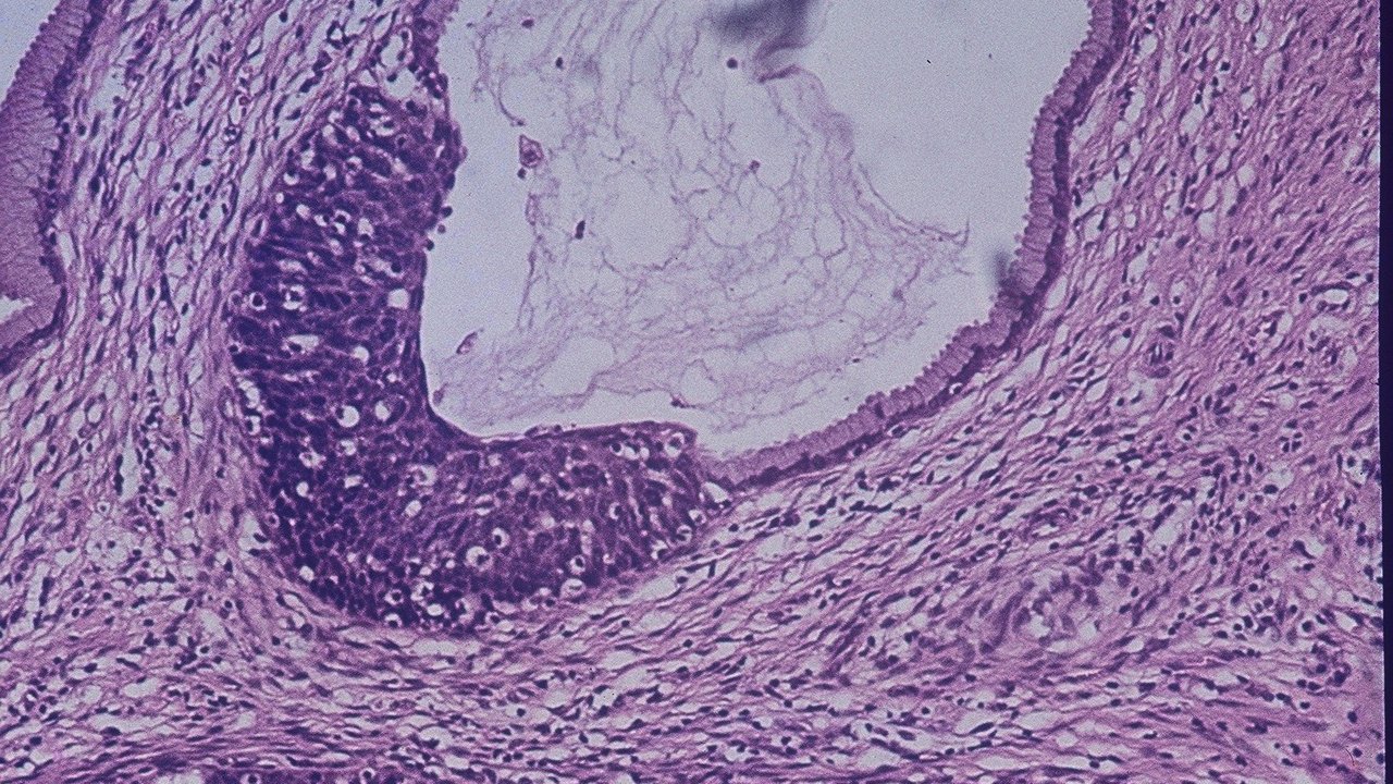 Biopsy Of Cervix