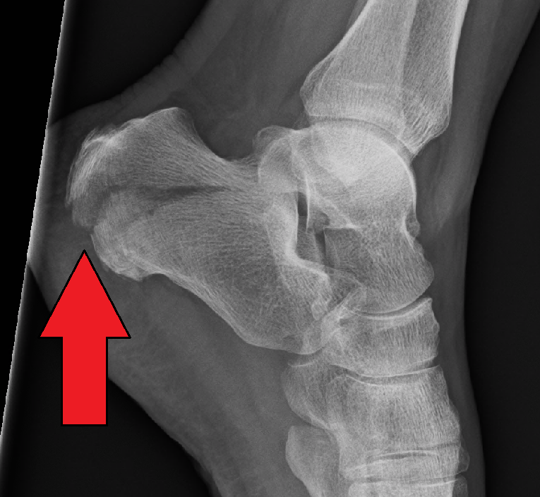 Calcaneus Fracture