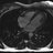 MRI of the heart.