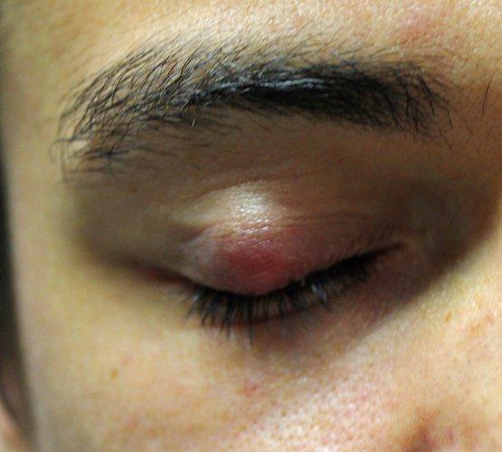 Facts about Chalazion