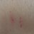 Chicken Pox.