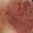 Psoriasis.