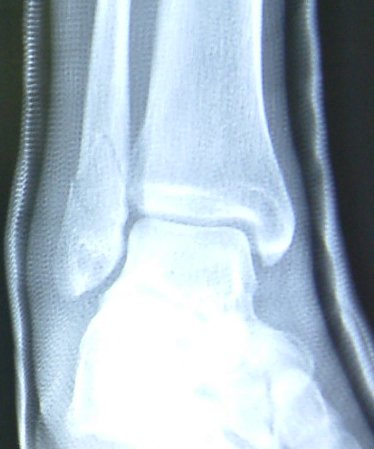 Fracture Of The Fibula