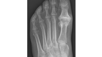 X-ray of the foot showing Hallux rigidus.