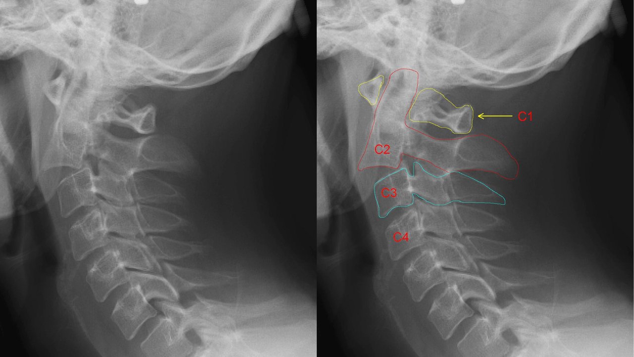 Cervical Fracture