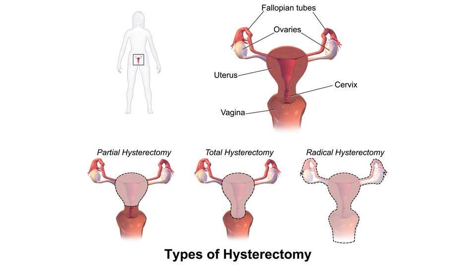 hysterectomy-abdominal-with-salpingo-oophorectomy