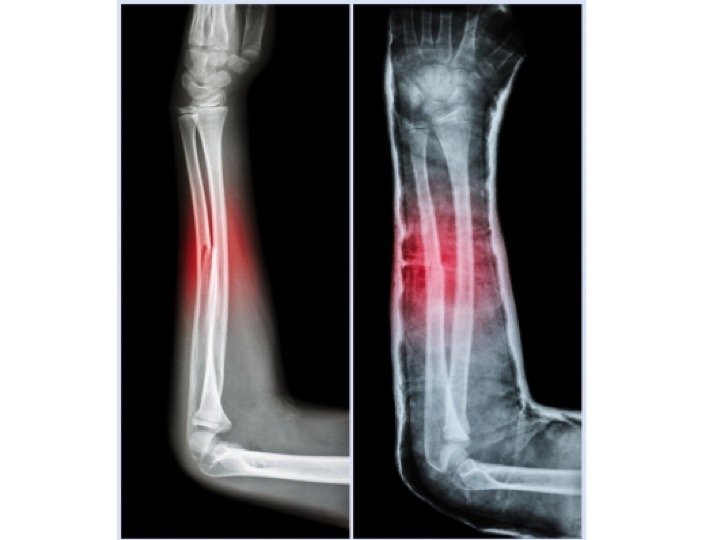 Fracture of the Ulnar Bone