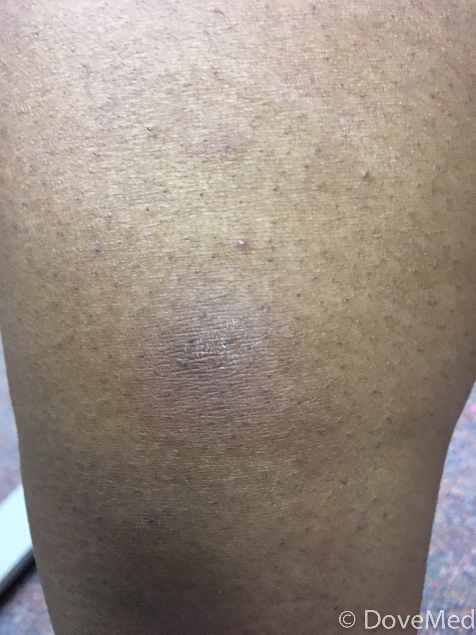 Erythema Nodosum