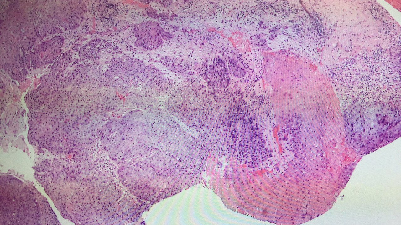 squamous-cell-carcinoma-of-tongue