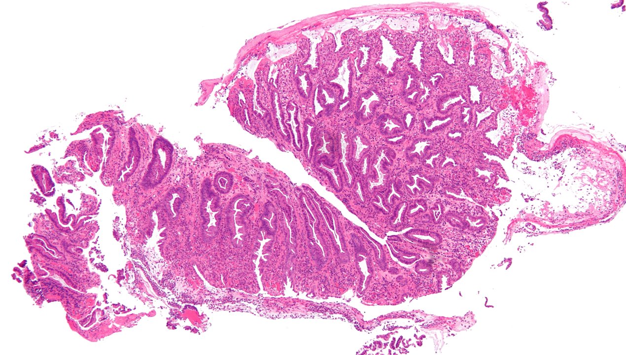 Ischemic Colitis
