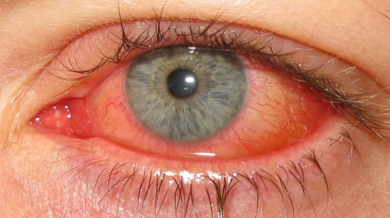 Epidemic Keratoconjunctivitis (EKC)