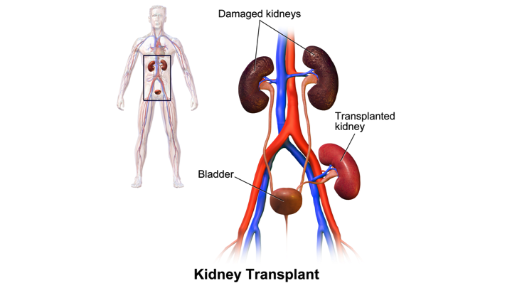 Kidney Transplantation