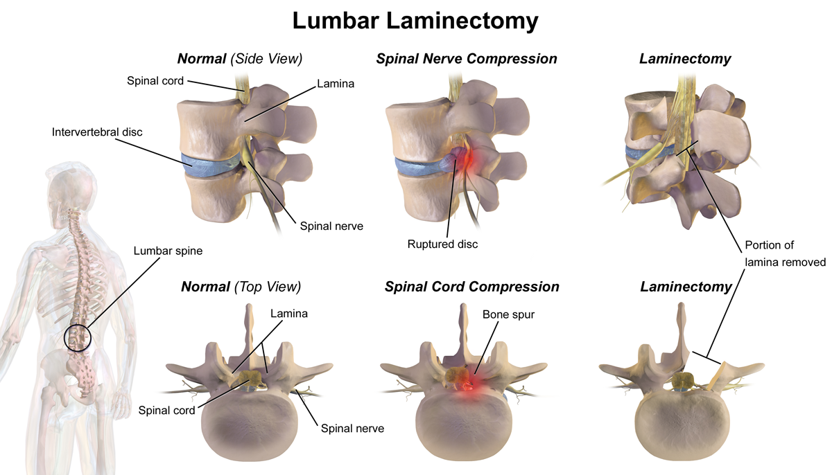 Lumbar Laminectomy And Rhizolysis