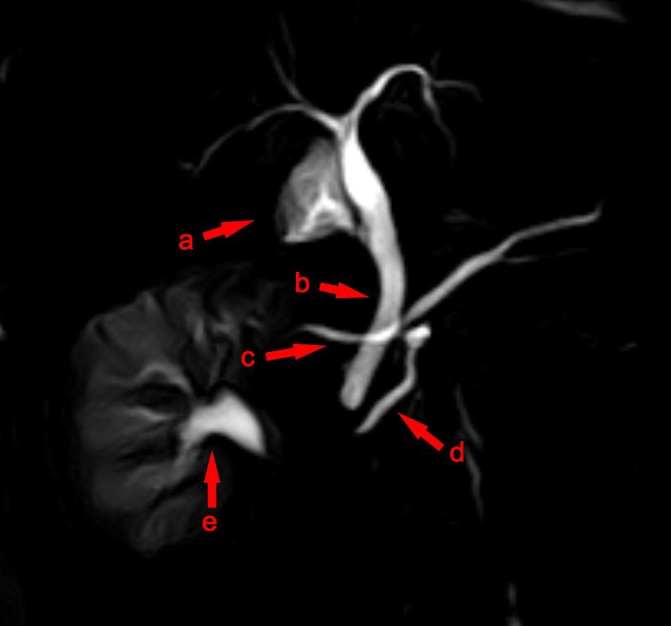 Magnetic Resonance Cholangiopancreatography (MRCP)