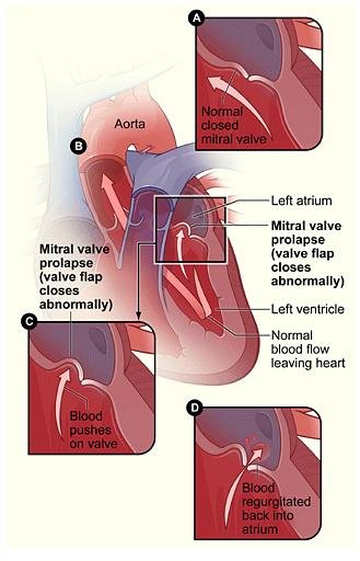 mitral-valve-prolapse-mvp