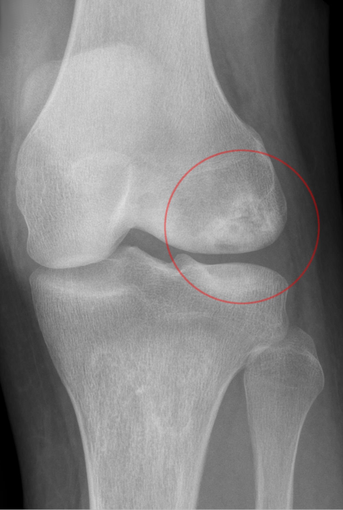 Osteonecrosis of the Knee