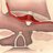 Over-Under tympanoplasty places a fascia graft over the malleus and under the remaining ear drum.