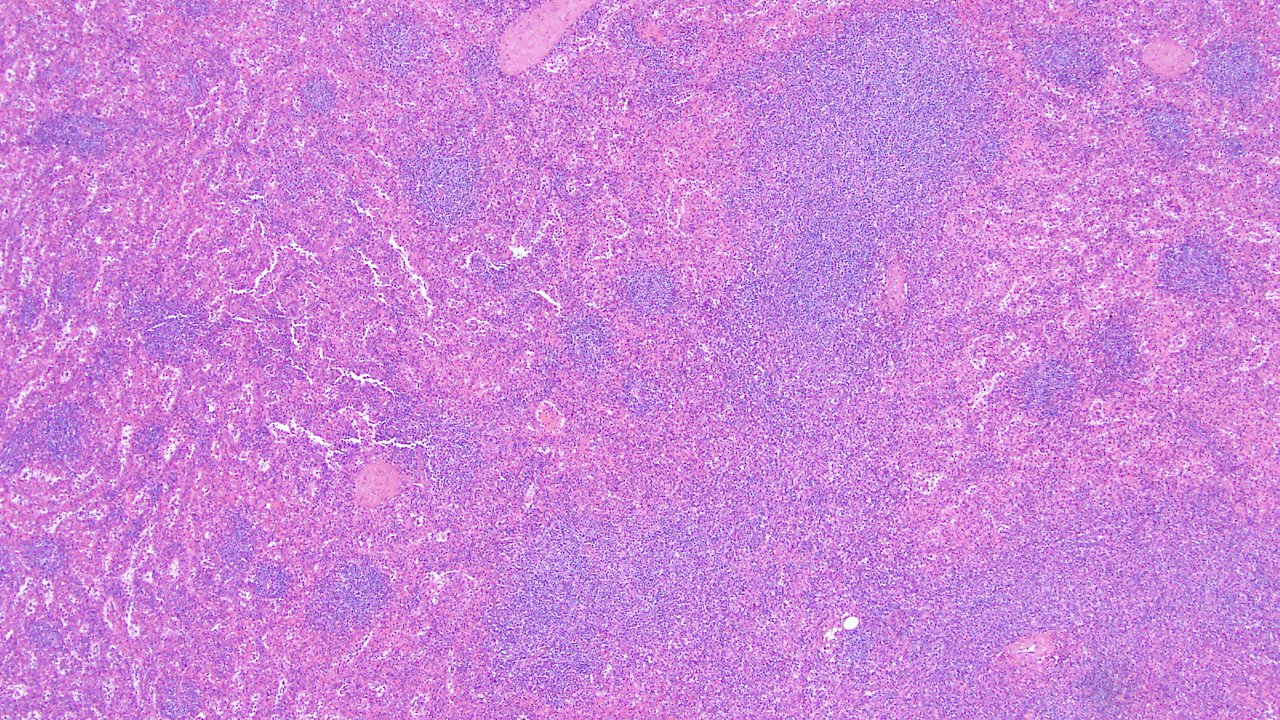 Lymphoma of Testis