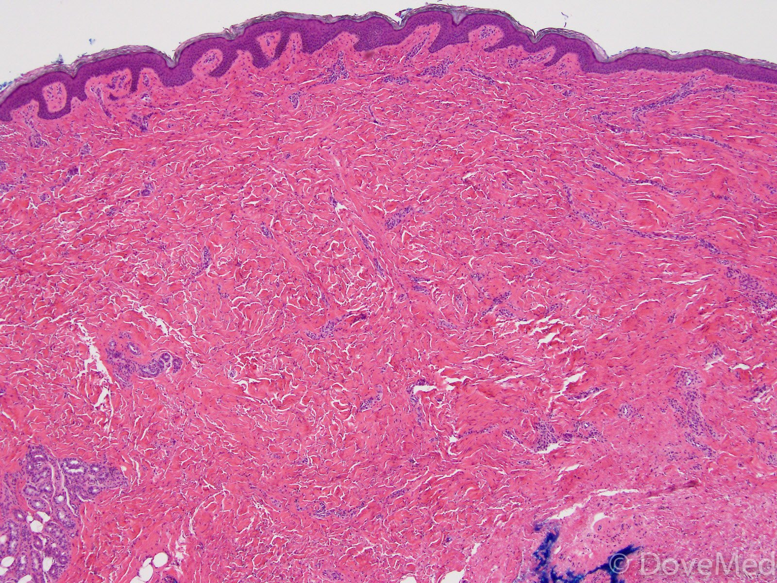 Scleroderma as related to Connective Tissue Disorders - Pictures